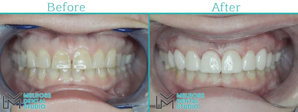 Smile makeover with porcelain veneers at Melrose Dental Studio, before and after, case 3